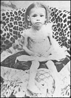 Young girl victim of malnutrition. 
