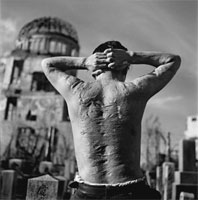 Hiroshima atomic bomb victim.